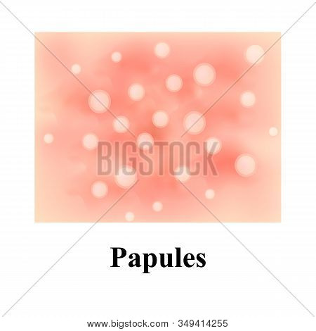 Papules On The Skin. Acne. Pimples On The Skin. Infographics. Illustration.