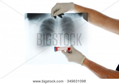 2019 Novel Coronavirus. 2019-nCoV.  Wuhan, China Coronavirus. Doctor with Lung X Ray examines a vile of blood infected with the Wuhan, China Coronavirus. Doctor in Protective suit with virus. 
