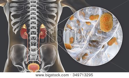 Acute Pyelonephritis Caused By Bacteria Acinetobacter Baumannii, Medical Concept, 3d Illustration