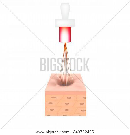Acne Scars. Laser Scar Atrophic Treatment. The Anatomical Structure Of The Skin With Acne. Illustrat