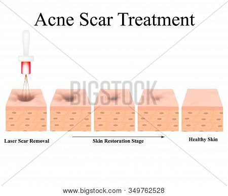 Acne Scars. Laser Scar Atrophic Treatment. The Anatomical Structure Of The Skin With Acne. Illustrat