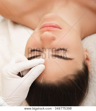 Acupuncture Treatment For Woman Headache And Migraine. Certified Acupuncturist Treats A Womans Migra