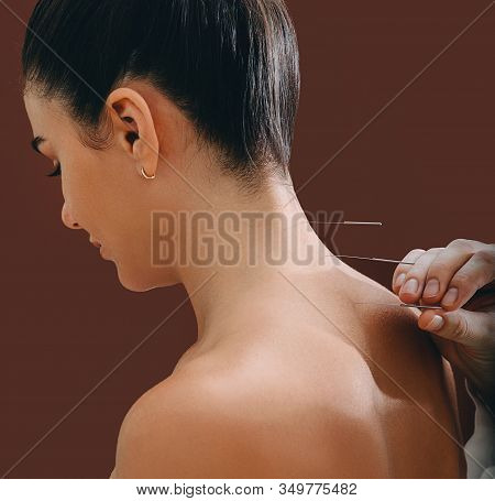 Acupuncture Needles In A Womans Spine Close-up On A Brown Background. Reflexologist Very Accurately 