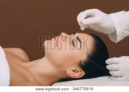 Acupuncture Treatment For Woman Headache And Migraine. Certified Acupuncturist Treats A Womans Migra