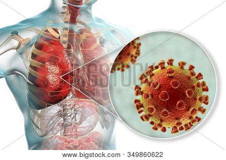 Pneumonia Caused By A Novel Chinese Wuhan Coronavirus 2019-ncov, Conceptual 3d Illustration
