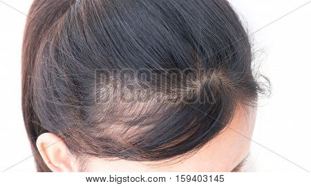 Woman serious hair loss problem for health care shampoo and beauty product concept