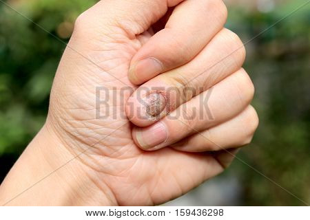 Fungus Infection On Nails Hand, Finger With Onychomycosis