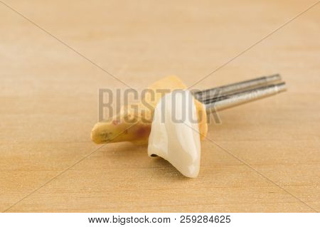 Cast And Cermet Dental Structures For Restoration Of Teeth
