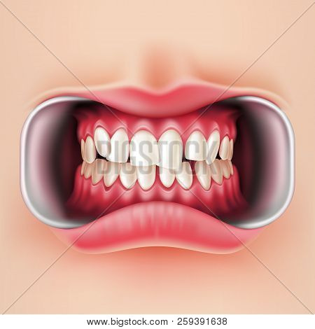 Vector Dental Braces, Oral Brakets System 3d