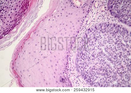 Basal Cell Carcinoma, Skin Cancer, Light Micrograph, Photo Under Microscope