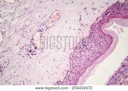 Basal Cell Carcinoma, Skin Cancer, Light Micrograph, Photo Under Microscope