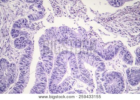 Esophageal Squamous Cell Carcinoma, Light Micrograph, Photo Under Microscope