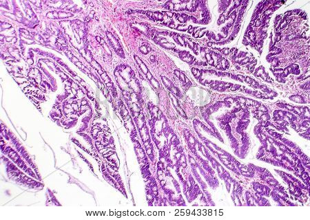 Colon Adenocarcinoma, Light Micrograph, Photo Under Microscope