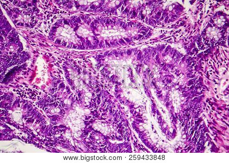 Colon Adenocarcinoma, Light Micrograph, Photo Under Microscope