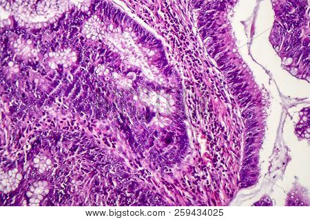 Colon Adenocarcinoma, Light Micrograph, Photo Under Microscope