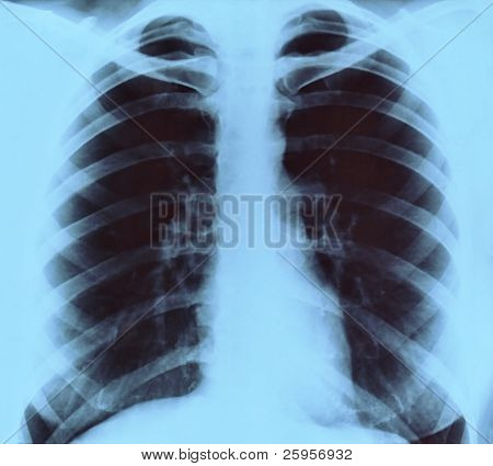 Imagem de raio x frontal do peito para diagnóstico médico
