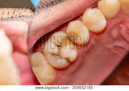 Treatment Tooth Decay With Subsequent Filling With Photopolymer Material. Close-up, Macro