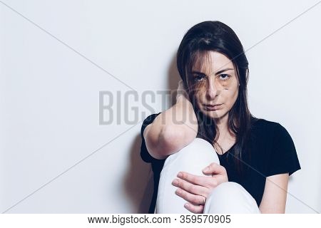 Young Woman With Bruises On Her Face From The Abuse Looks At The Camera With Frustration And Hate Sp