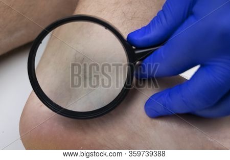 A Man In Consultation With A Vascular Surgeon. A Doctor Examines A Leg With Swollen Veins. Varicose