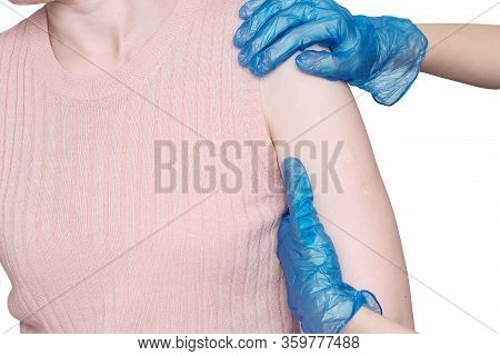 Doctor Or Nurse Examine Tuberculosis Vaccine Bcg Marks On The Shoulder Of An Adult Woman Made In Chi