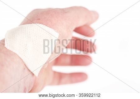 Chemical Burn On The Wrist Skin With Hydroxide Sodium Acid. Festering And Deep Wound. Household Acci