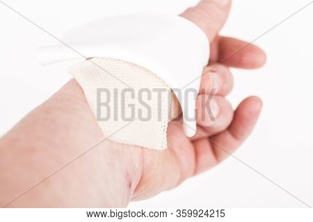 Chemical Burn On The Wrist Skin With Hydroxide Sodium Acid. Festering And Deep Wound. Household Acci