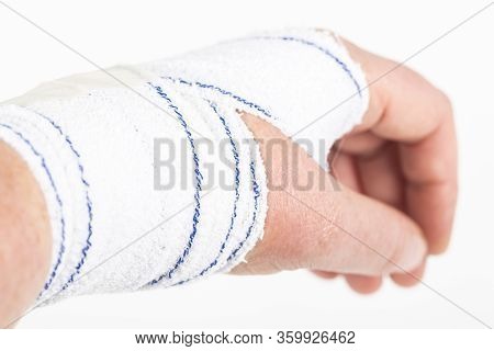 Chemical Burn On The Wrist Skin With Hydroxide Sodium Acid. Festering And Deep Wound. Household Acci
