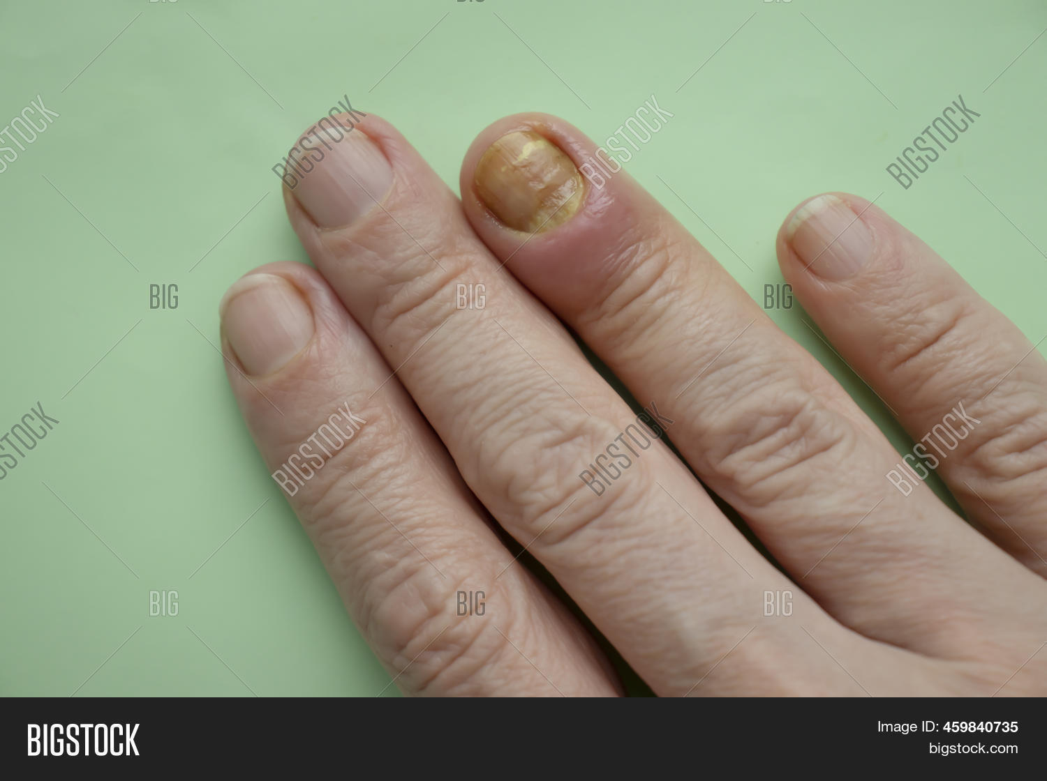 Paronychia Disease Image & Photo (Free Trial) Bigstock