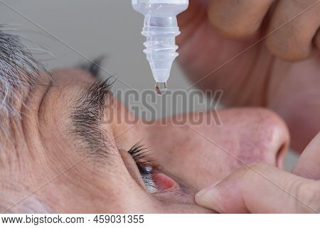 Close-up View Of A Senior Asian Adult Male Using Eye Drop In Right Eye After Catarct Surgery.