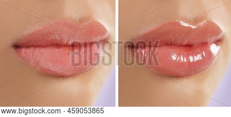 Collage With Photos Of Woman With Dry And Moisturized Lips, Closeup. Banner Design