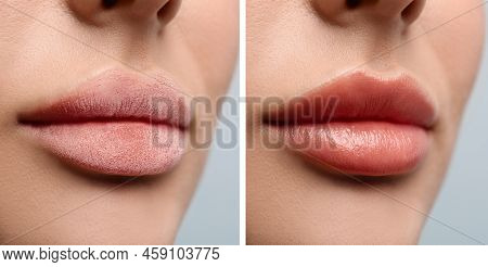 Collage With Photos Of Woman With Dry And Moisturized Lips, Closeup. Banner Design
