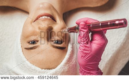 Cosmetologists Hand Doing Procedure Of Microneedling To The Patients Smiling Face. Aesthetic Cosmeto