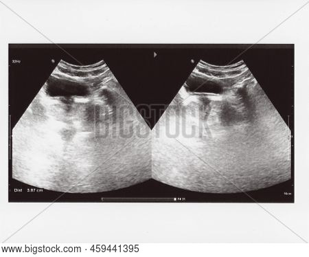 Full Abdomen Ultrasound Sonogram