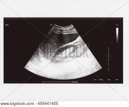 Full Abdomen Ultrasound Sonogram