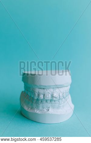 Plaster Model Of Human Teeth With Transparent Aligner, Essix Retainer Or Orthodontic Silicone Traine