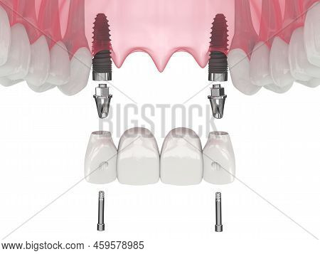 3d Render Of Jaw With Dental Incisors Bridge Supported By Implants Over White Background