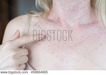 Real Biorevitalization Of The Skin On A White Background. Traces Of Injections Of Biorevitalization 