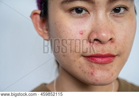 Close Up Of Ugly Asian Woman Having Acne Inflamed On Her Face. Inflamed Acne Consists Of Swelling, R