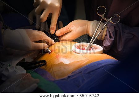 Video Assist Thoracotomy