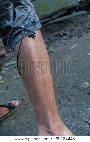 Leg Covered By The Bites Of Sandflies, Jungle In Peru
