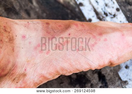 Leg Covered By The Bites Of Sandflies, Jungle In Peru