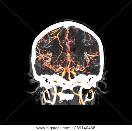 Ct Angiography  Of The Brain Coronal View / 3d Rendering Image  Showing Vessels In Human Head.