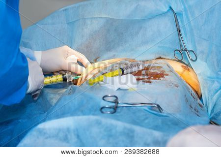 Surgical Team Performing Cosmetic Surgery In Hospital Operating Room. Surgeon Working On A Patient. 