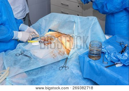Surgical Team Performing Cosmetic Surgery In Hospital Operating Room. Surgeon Working On A Patient. 
