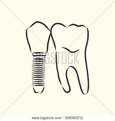 Vector Illustration. Sketches, Dental Implants. Dental Implant, Vector Sketch Illustration