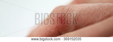 Close-up Of Person Hand Cutting. Dry Fissured Skin. Wounds And Cracked On Fingers. Skin Disease. Sli