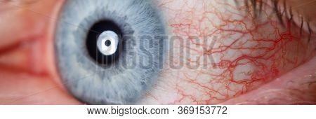 Irritated Male Blue Eye Full With Capillar Net Close-up