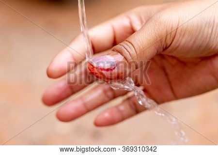 The Saline Solution Is Poured Over The Human Finger With Black Nails, Bruised With Blood.