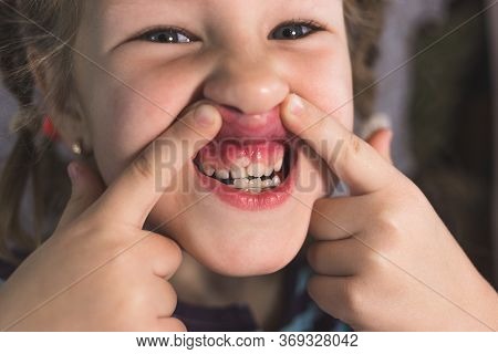 Adult Permanent Teeth Coming In Front Of The Child's Baby Teeth: Shark Teeth. Little Girl's Open Mou