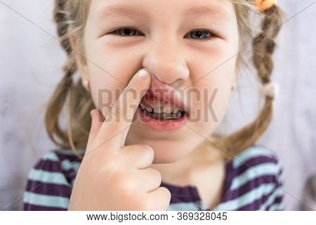 Adult Permanent Teeth Coming In Front Of The Child's Baby Teeth: Shark Teeth. Little Girl's Open Mou